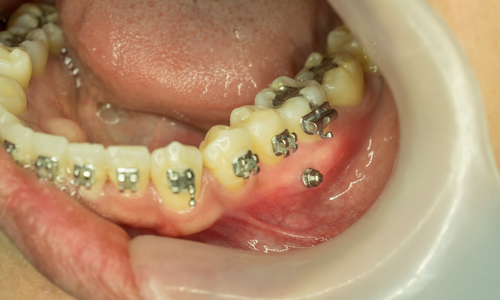 After mini dental implants picture